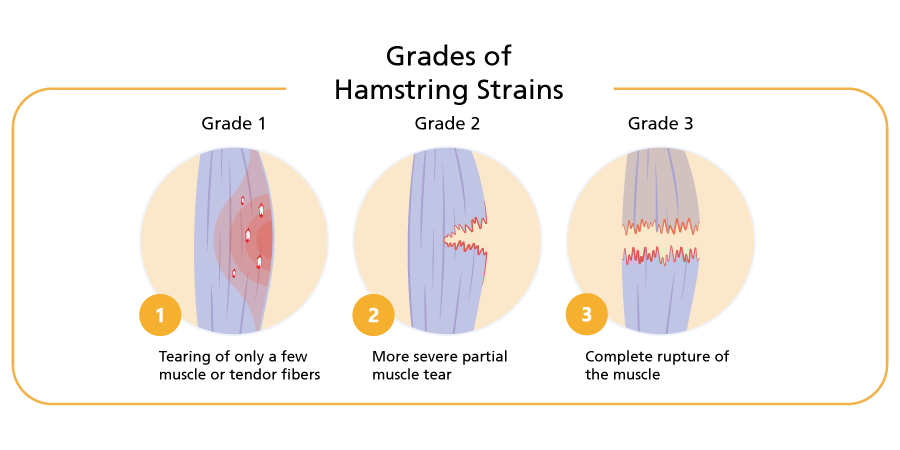Grades of Hamstring Strains