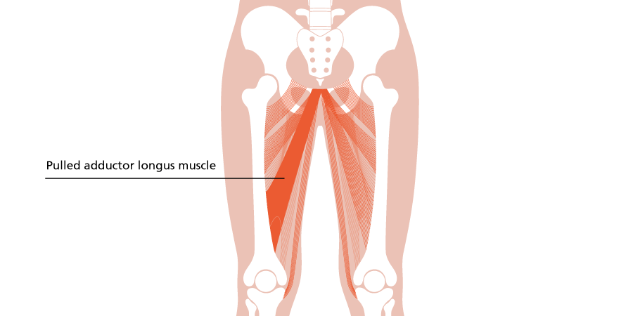 Pulled Adductor Longus Muscle diagram