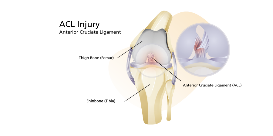 ACL Injury Anterior Cruciate Ligament